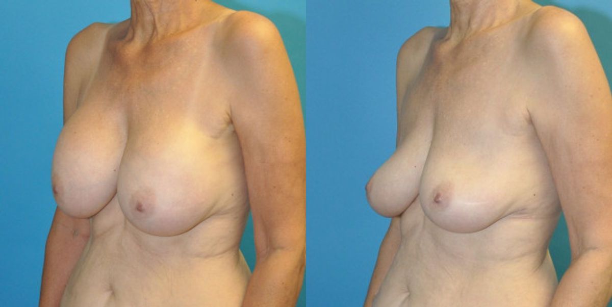 Breast Implant Removal #5 - Before and After