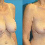 Breast Implant Removal #5 - Before and After