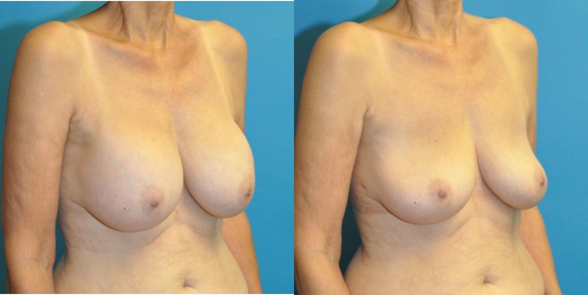 Breast Implant Removal #5 - Before and After
