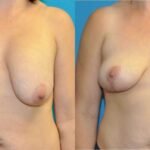 Breast Implant Removal and Lift #6 - Before and After