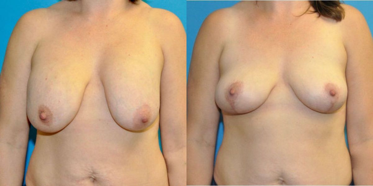 Breast Implant Removal and Lift #6 - Before and After