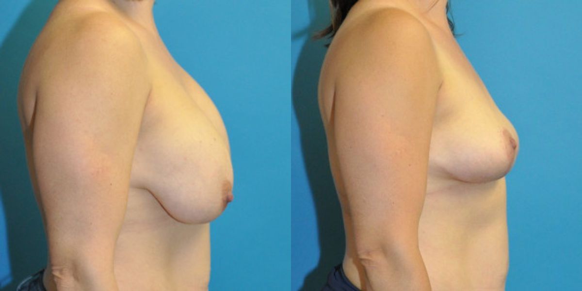 Breast Implant Removal and Lift #6 - Before and After