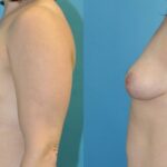 Breast Implant Removal and Lift #6 - Before and After