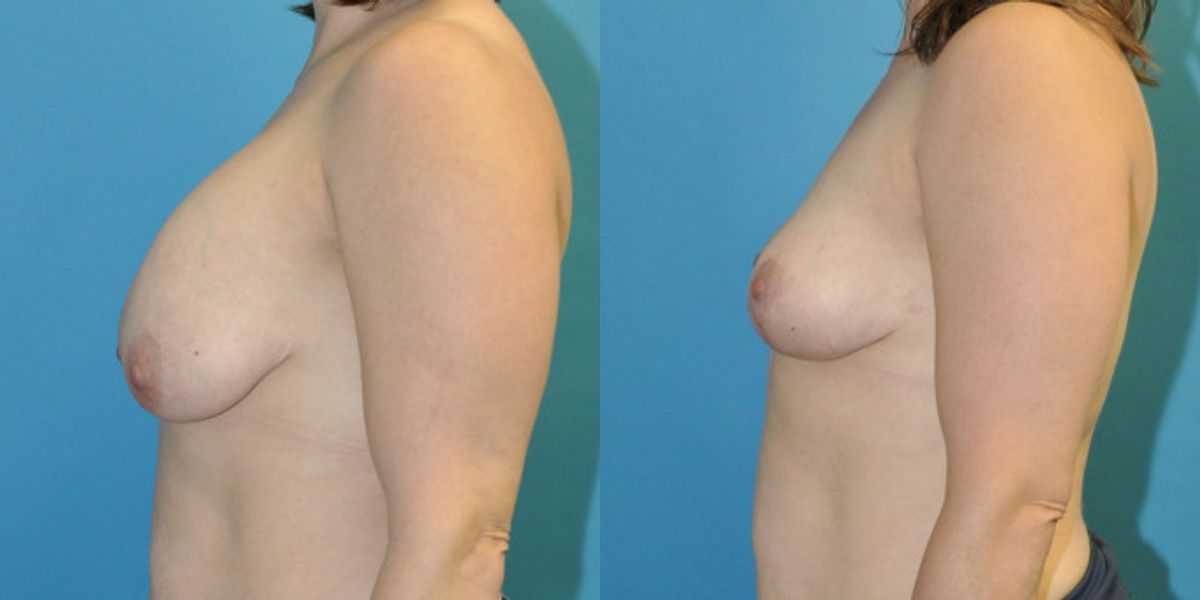 Breast Implant Removal and Lift #6 - Before and After