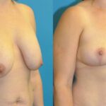 Breast Implant Removal and Lift #6 - Before and After