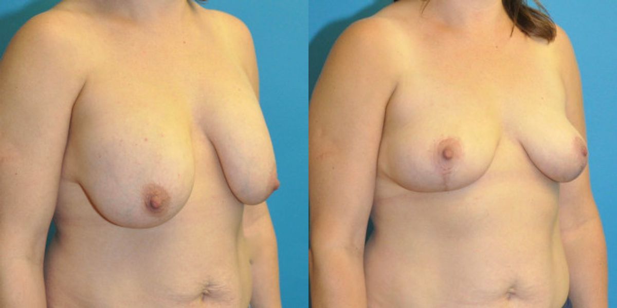 Breast Implant Removal and Lift #6 - Before and After