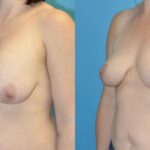 Breast Implant Removal and Lift #6 - Before and After