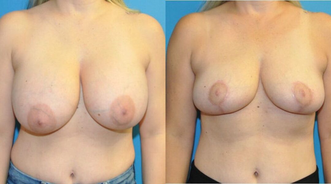 Breast Implant Removal and Lift #7