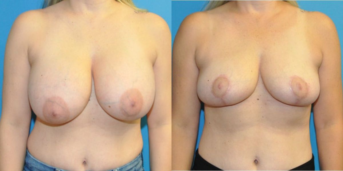 Breast Implant Removal and Lift #7 - Before and After