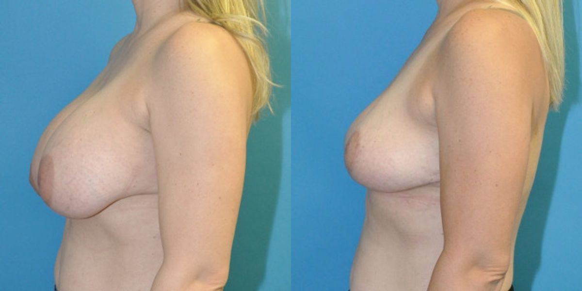 Breast Implant Removal and Lift #7 - Before and After