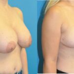 Breast Implant Removal and Lift #7 - Before and After