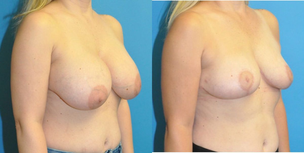 Breast Implant Removal and Lift #7 - Before and After