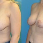 Breast Implant Removal and Lift #7 - Before and After