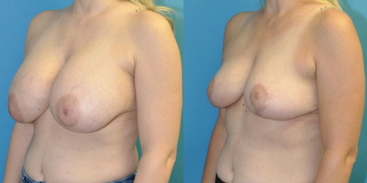 Breast Implant Removal and Lift #7 - Before and After