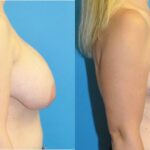 Breast Implant Removal and Lift #7 - Before and After