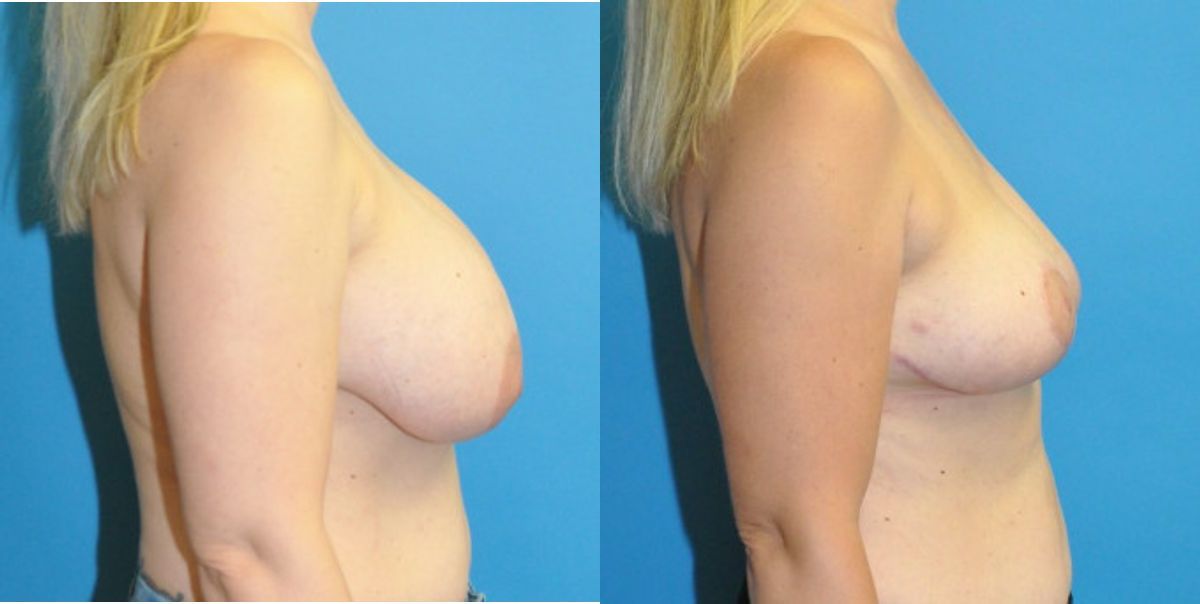 Breast Implant Removal and Lift #7 - Before and After