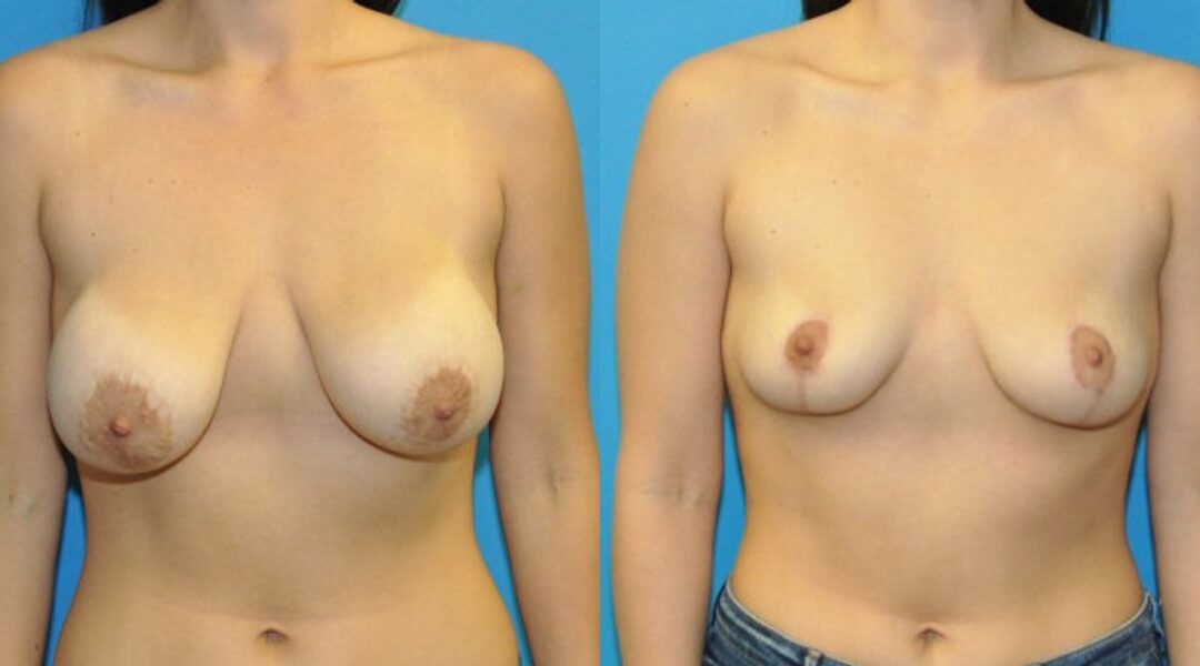 Breast Implant Removal and Lift #8