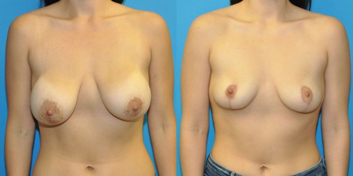 Breast Implant Removal and Lift #8 - Before and After
