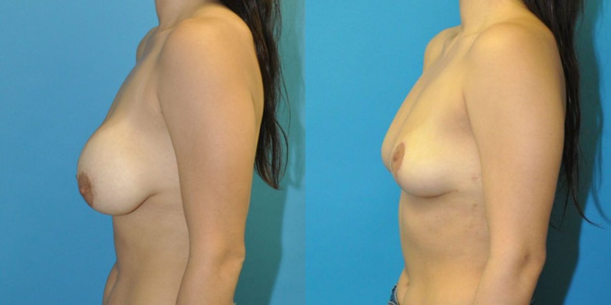 Breast Implant Removal and Lift #8 - Before and After