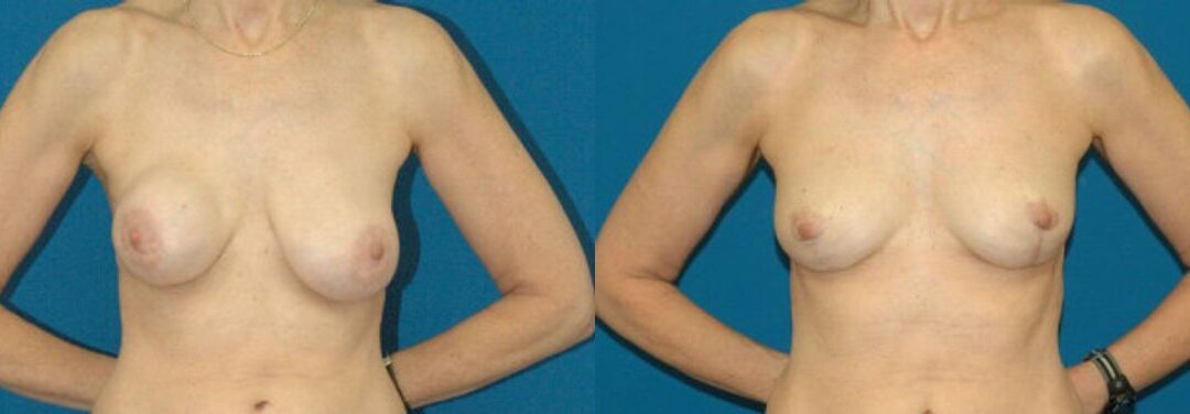 Breast Implant Revision #1