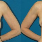 Breast Implant Revision #1 - Before and After