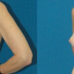 Breast Implant Revision #1 - Before and After