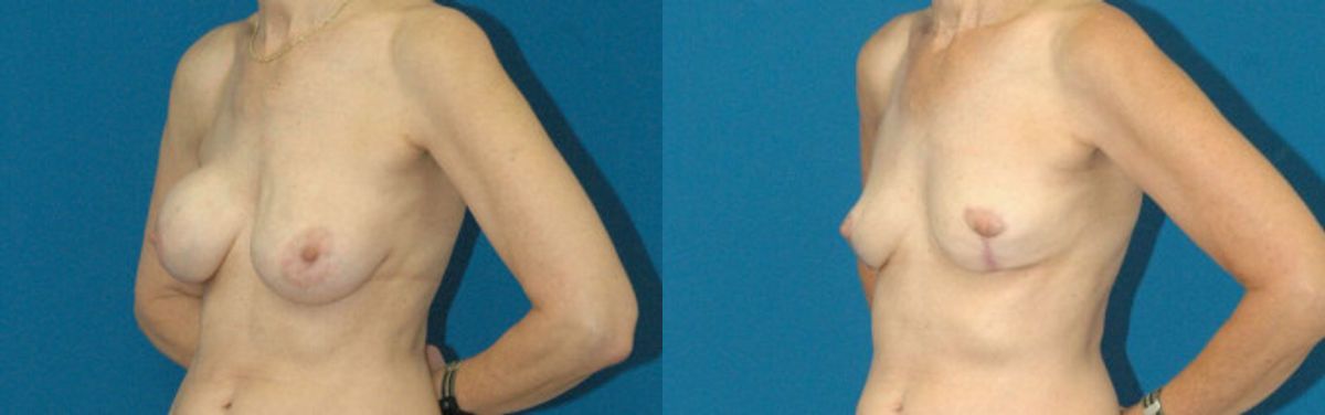 Breast Implant Revision #1 - Before and After