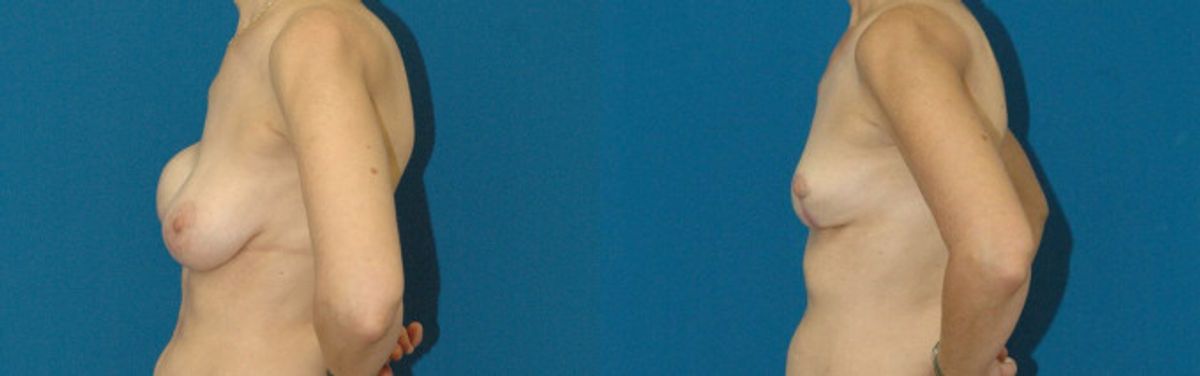 Breast Implant Revision #1 - Before and After