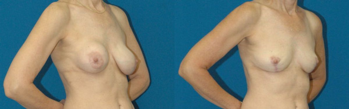 Breast Implant Revision #1 - Before and After