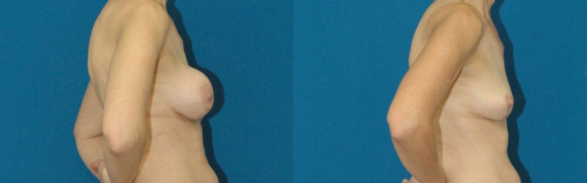 Breast Implant Revision #1 - Before and After