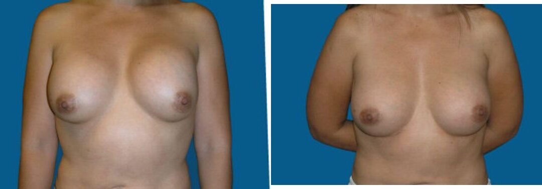 Breast Implant Revision #2