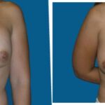 Breast Implant Revision #2 - Before and After