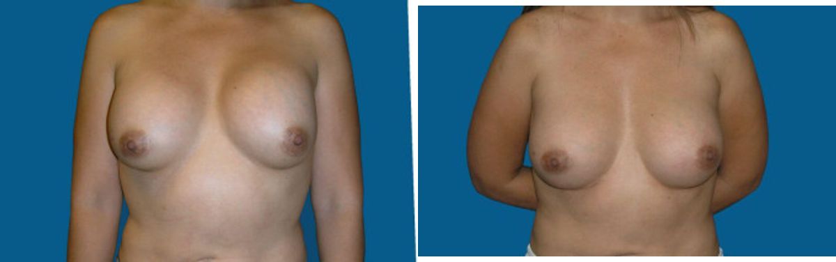 Breast Implant Revision #2 - Before and After