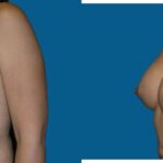 Breast Implant Revision #2 - Before and After