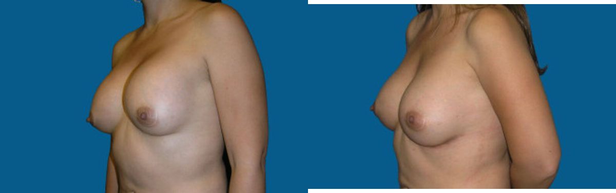 Breast Implant Revision #2 - Before and After