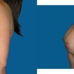 Breast Implant Revision #2 - Before and After