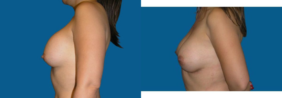 Breast Implant Revision #2 - Before and After