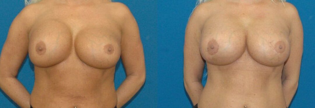Breast Implant Revision #3