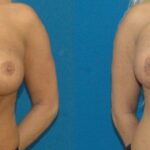 Breast Implant Revision #3 - Before and After