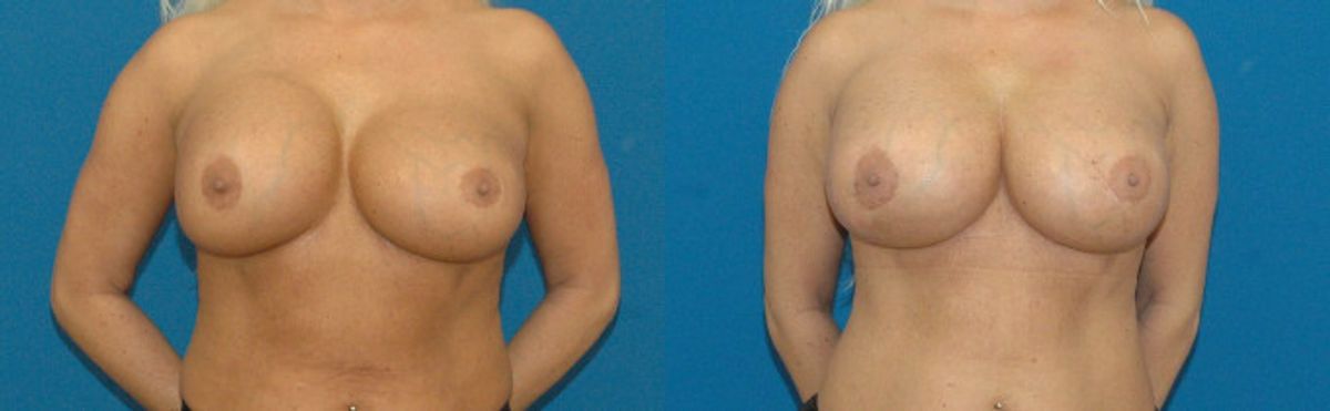 Breast Implant Revision #3 - Before and After