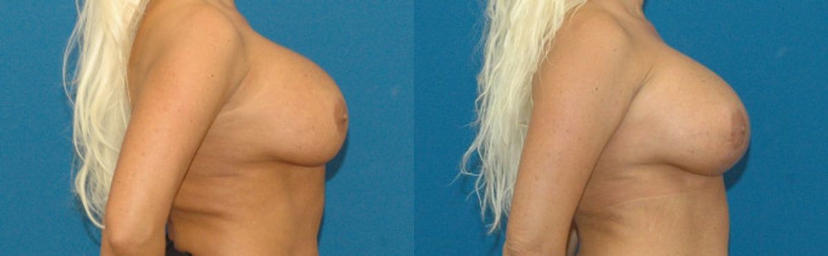 Breast Implant Revision #3 - Before and After