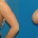Breast Implant Revision #3 - Before and After