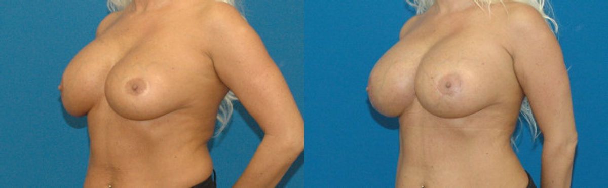 Breast Implant Revision #3 - Before and After