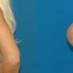 Breast Implant Revision #3 - Before and After