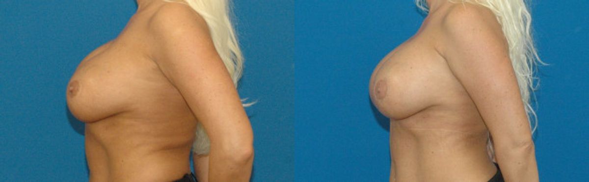 Breast Implant Revision #3 - Before and After