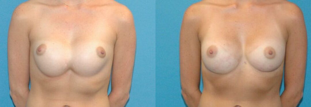 Breast Implant Revision #4