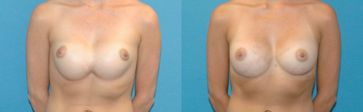 Breast Implant Revision #4 - Before and After