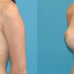 Breast Implant Revision #4 - Before and After