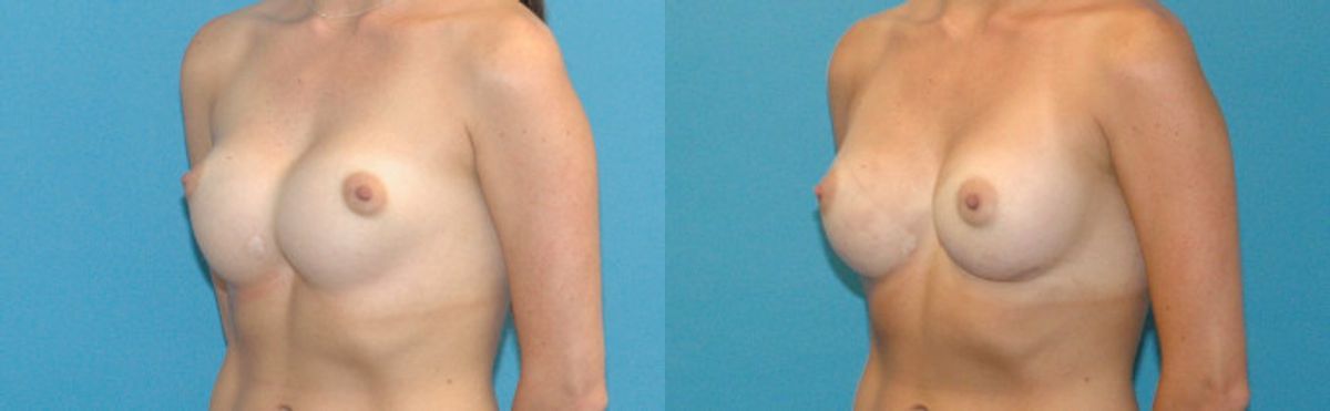 Breast Implant Revision #4 - Before and After