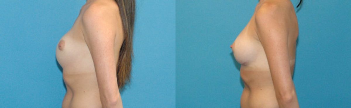 Breast Implant Revision #4 - Before and After